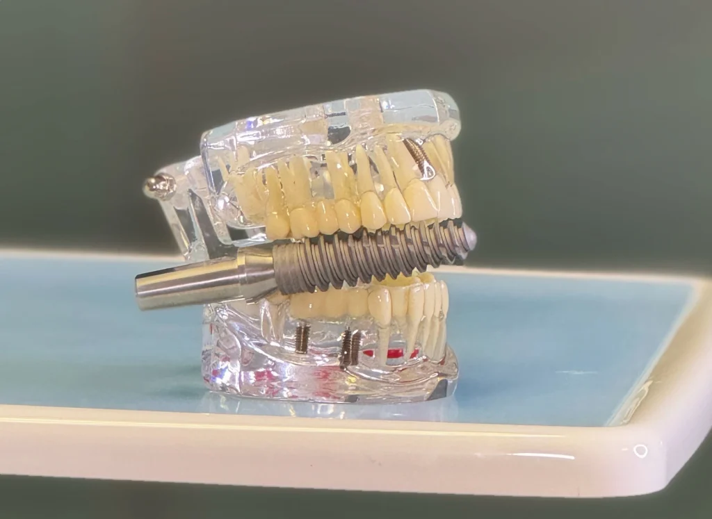 Glossario Implantologia - Come cambia il sorriso dopo un impianto dentale
