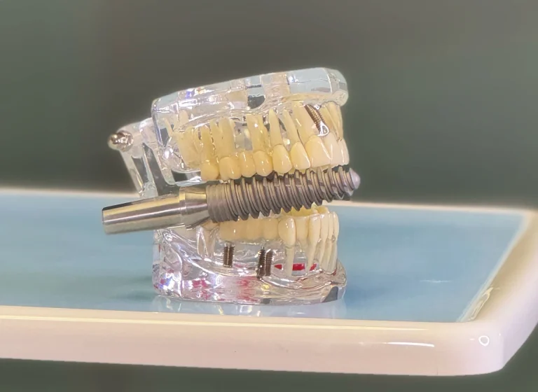 Glossario Implantologia - Come cambia il sorriso dopo un impianto dentale